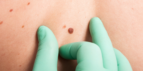 Een betaalbare en draagbare huidkanker detector heeft de Dyson Award gewonnen