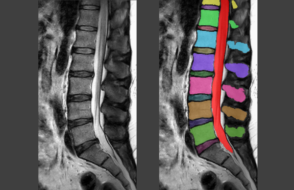 Beknelde zenuw of scheefstand: AI vindt de oorzaak van lage rugpijn