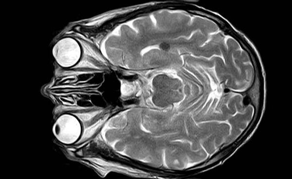 Overlijdenskans na een herseninfarct op jonge leeftijd duidelijk gedaald