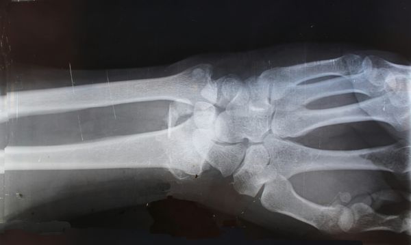 Radiologie zet AI in voor sneller beoordelen van botbreuken